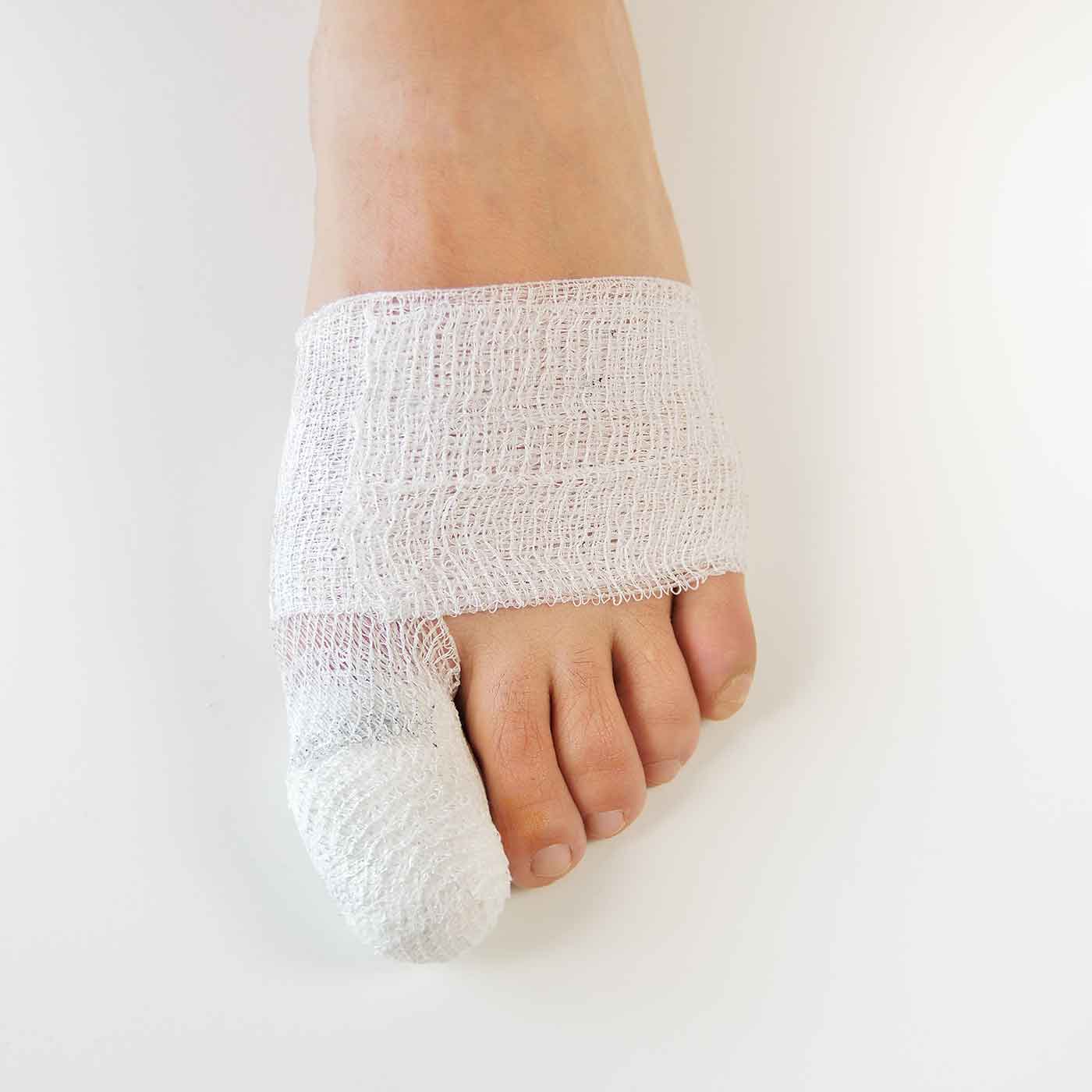 What to Expect During Bunion Surgery