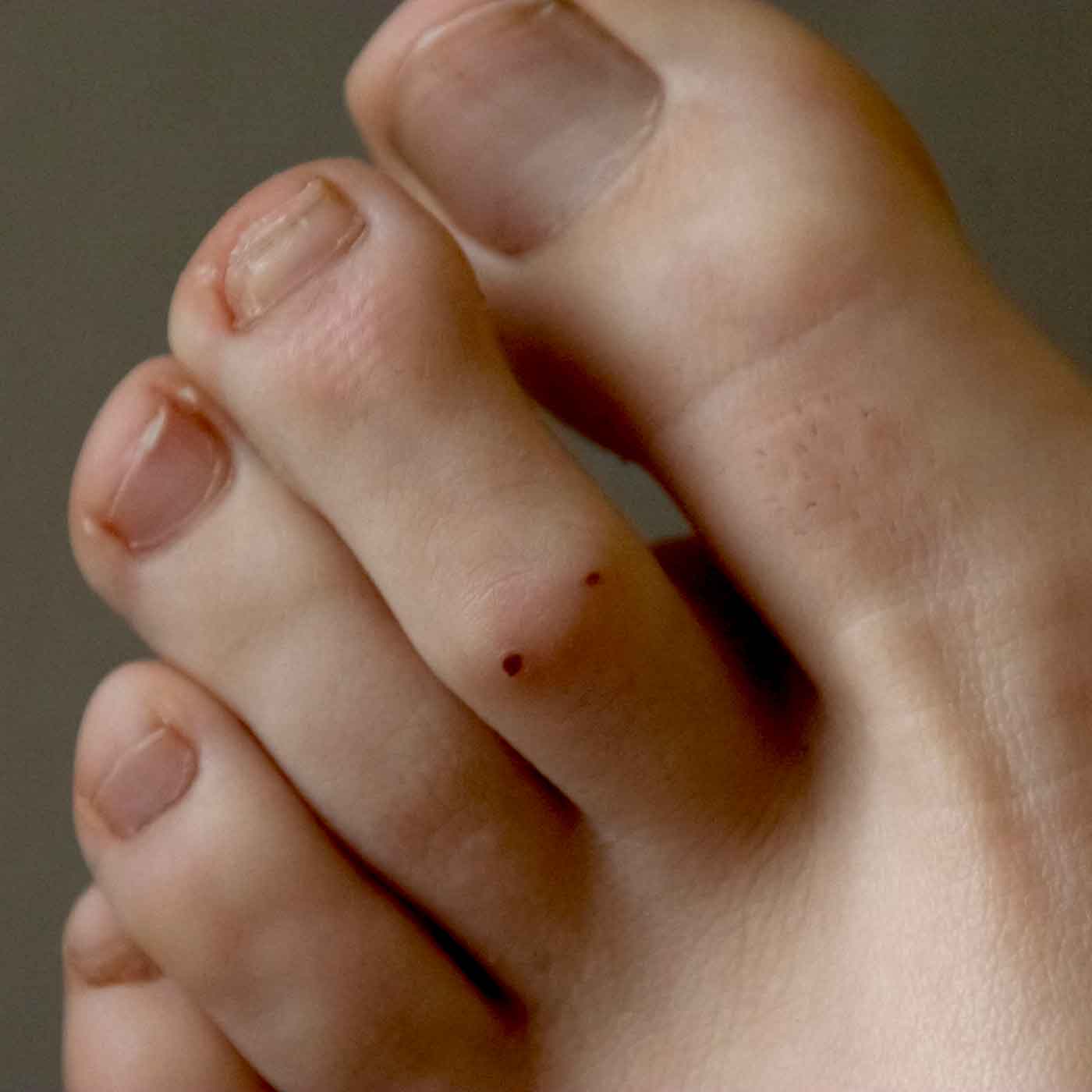 Signs and Symptoms of Claw Toes