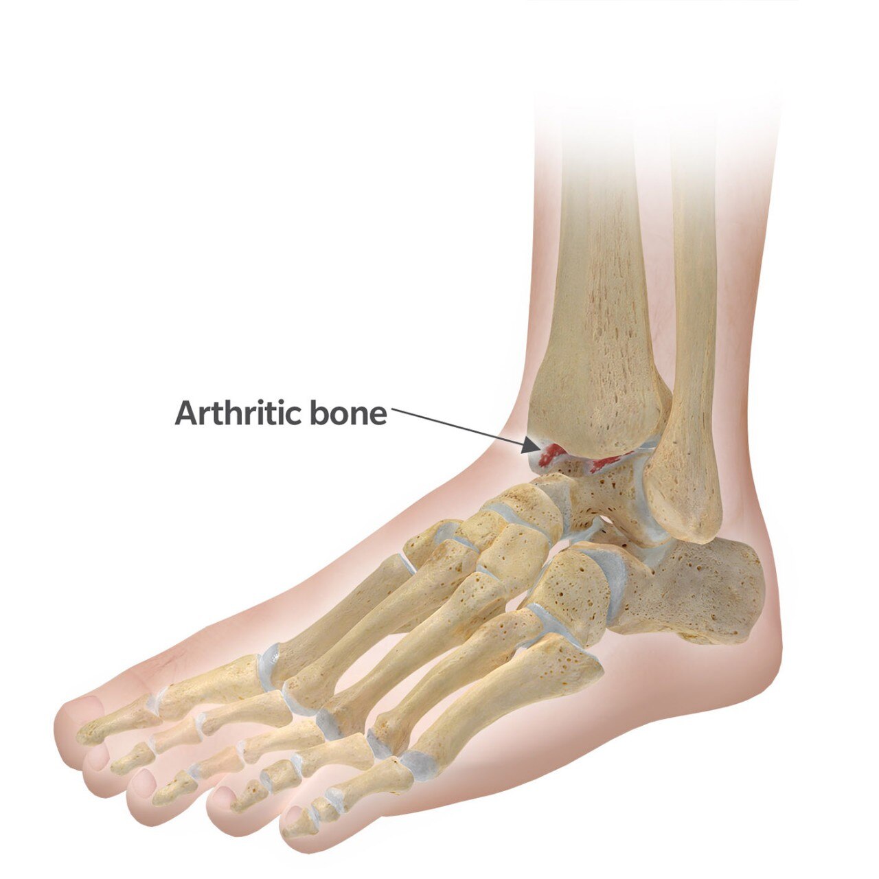 Arthritic bone
