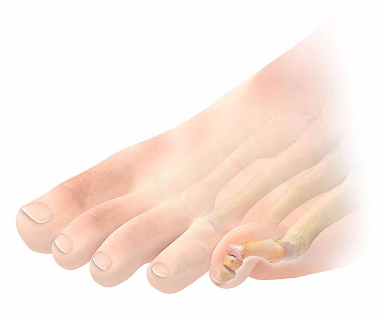 What is a Hammer Toe?  What is the Main Cause of Hammer Toes