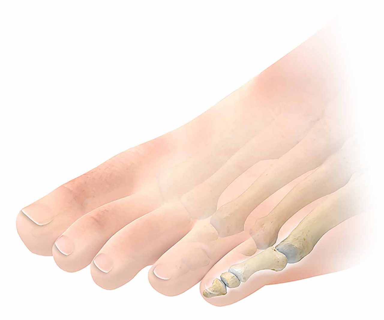 What is a Hammer Toe?, What is the Main Cause of Hammer Toes?