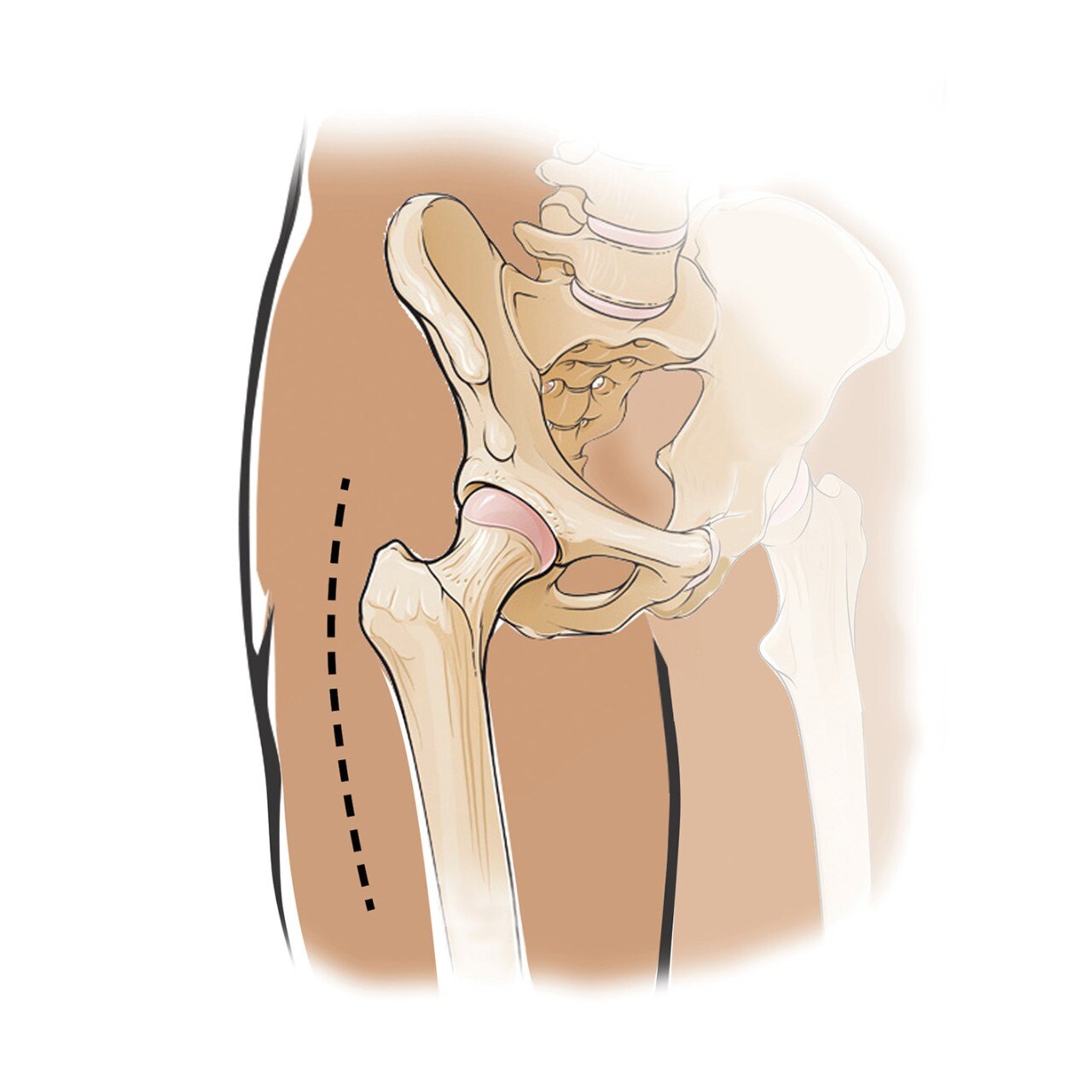 Hip Pain Relief & Surgical Treatment Options