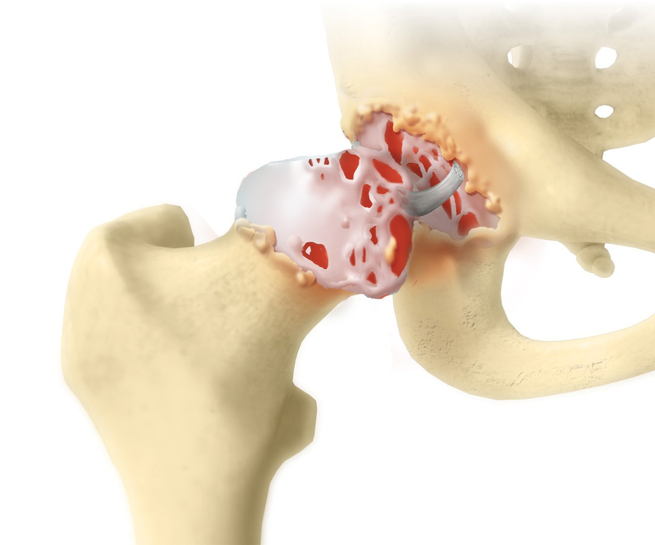 Hip Pain Relief Surgical Treatment Options