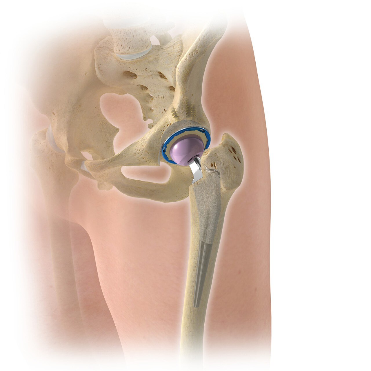 Guide to Hip Pain Relief and Treatment Options - Orthopedic