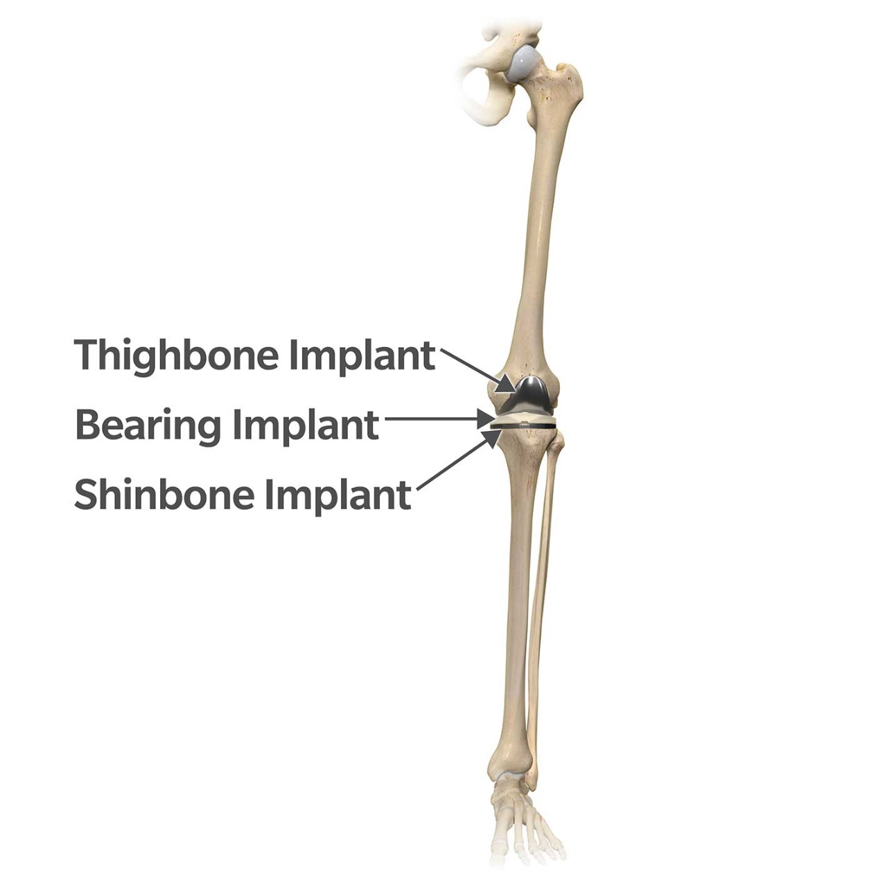 Knee Implant Size and Shape Do They Matter?
