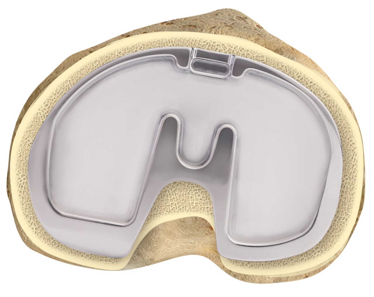 Knee Implant Size and Shape Do They Matter?