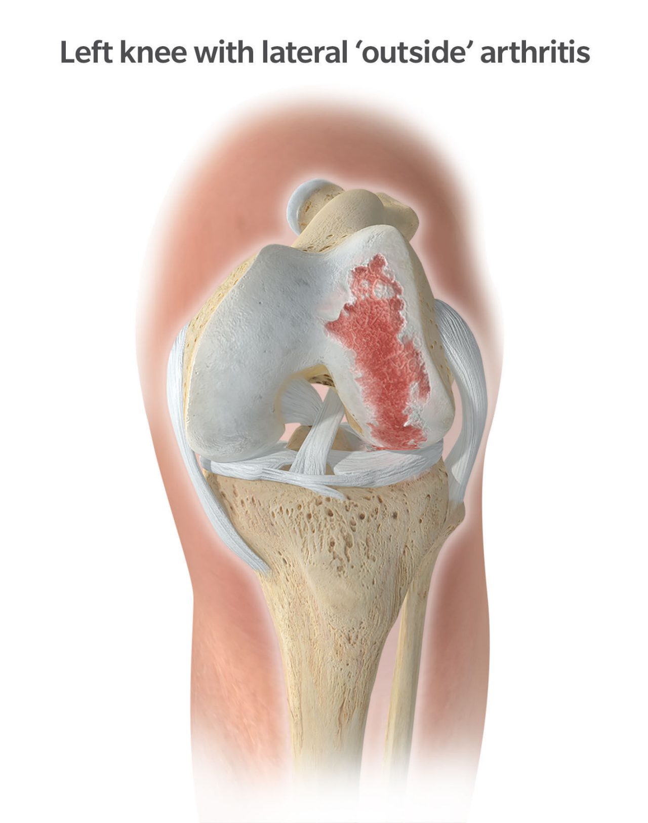 Knee Pain Explained