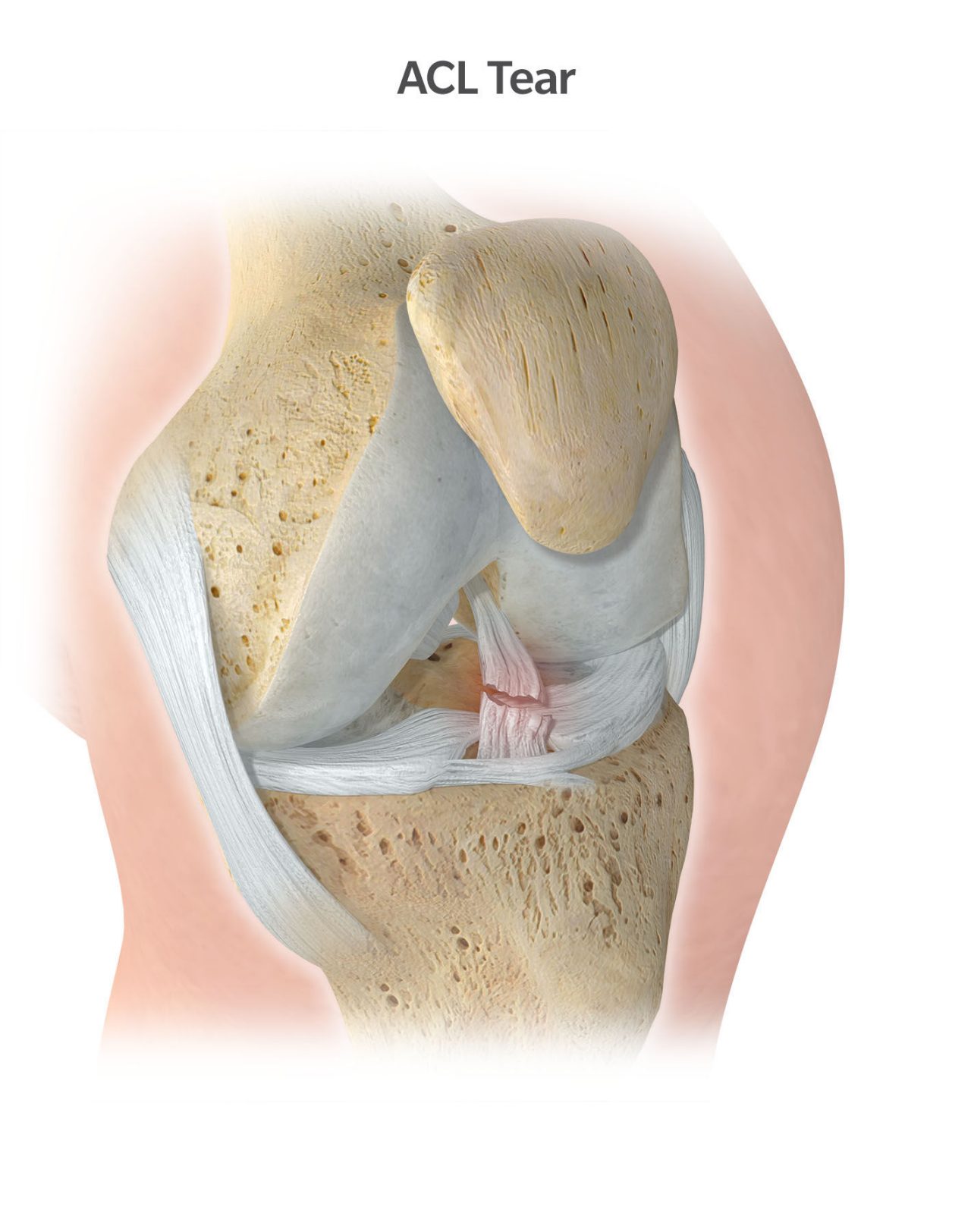 Knee Pain Explained