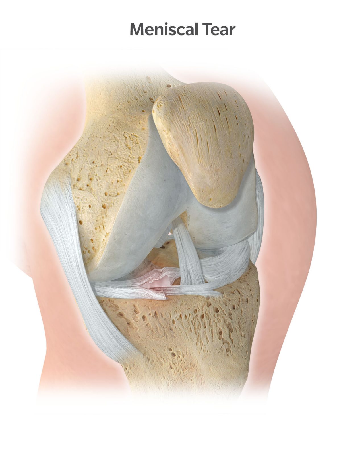 Meniscal tear