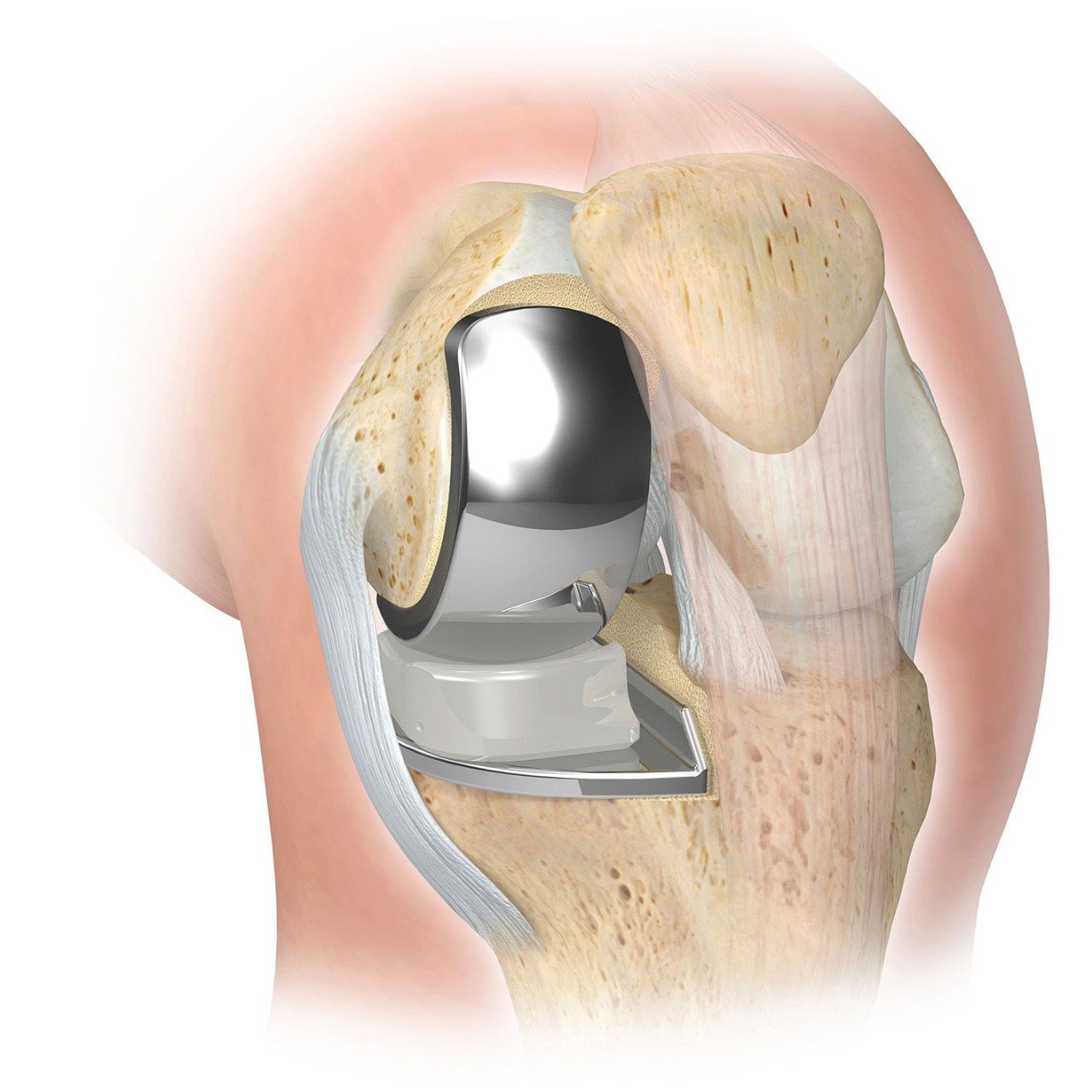 Knee Pain Relief Surgical Treatment Options