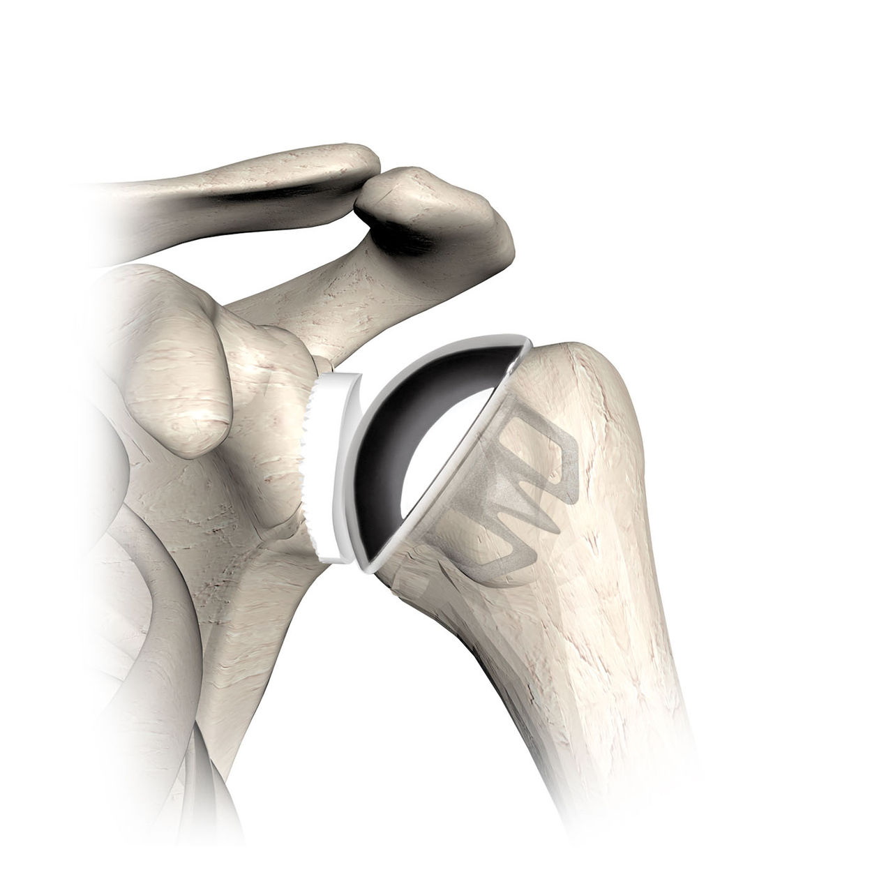 Shoulder Pain Relief Surgical Treatment Options