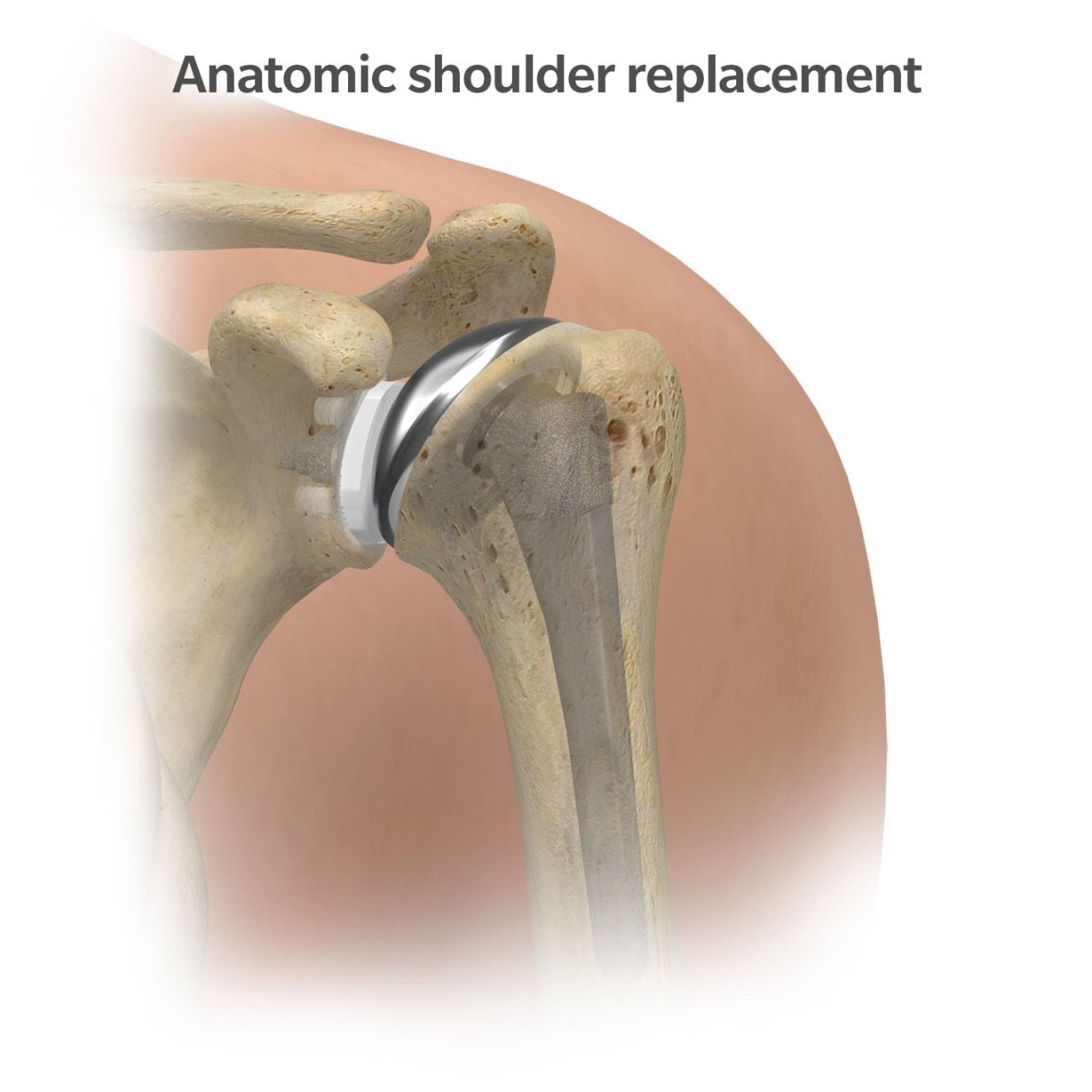 Shoulder Pain Relief – Surgical Treatment Options