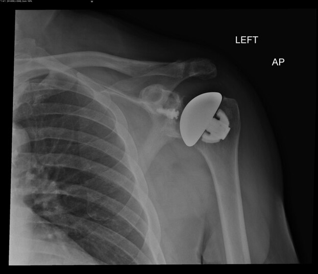 X-ray of a stemless anatomic shoulder replacement